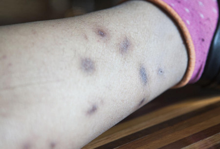 长春男子酷爱“毒宠” 被咬上百次险丧命