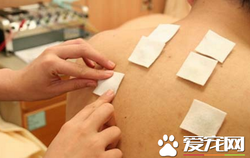 三伏贴必须得三伏第一天贴吗 三伏贴分几种